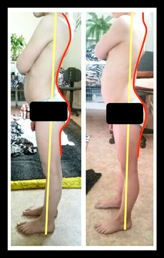 Keha taastav teraapia 10 Lapse seljakumeruste ja labajalgade korrektsioon